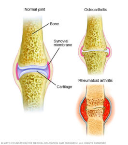 arthritis-comparison-diagram-mayo-clinic