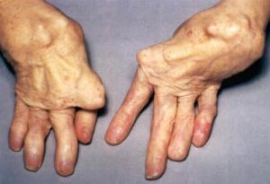 rheumatoid-arthritis-522x357