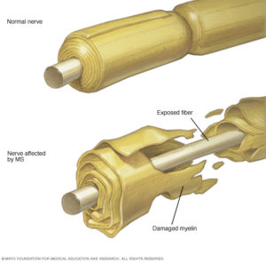 multiplesclerosisnervedamageschematic